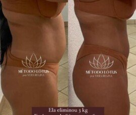 Galeria Antes e Depois – Resultados Reais de Tratamentos Estéticos - Recanto Terapêutico Vera Regina