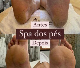 Galeria Antes e Depois – Resultados Reais de Tratamentos Estéticos - Recanto Terapêutico Vera Regina