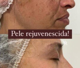 Galeria Antes e Depois – Resultados Reais de Tratamentos Estéticos - Recanto Terapêutico Vera Regina