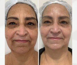 Galeria Antes e Depois – Resultados Reais de Tratamentos Estéticos - Recanto Terapêutico Vera Regina